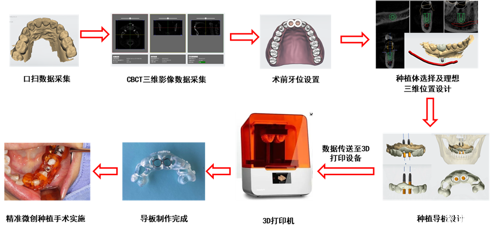 前海蛇口自贸区医院自主设计和打印数字化3d种植导板上线开启精准微创