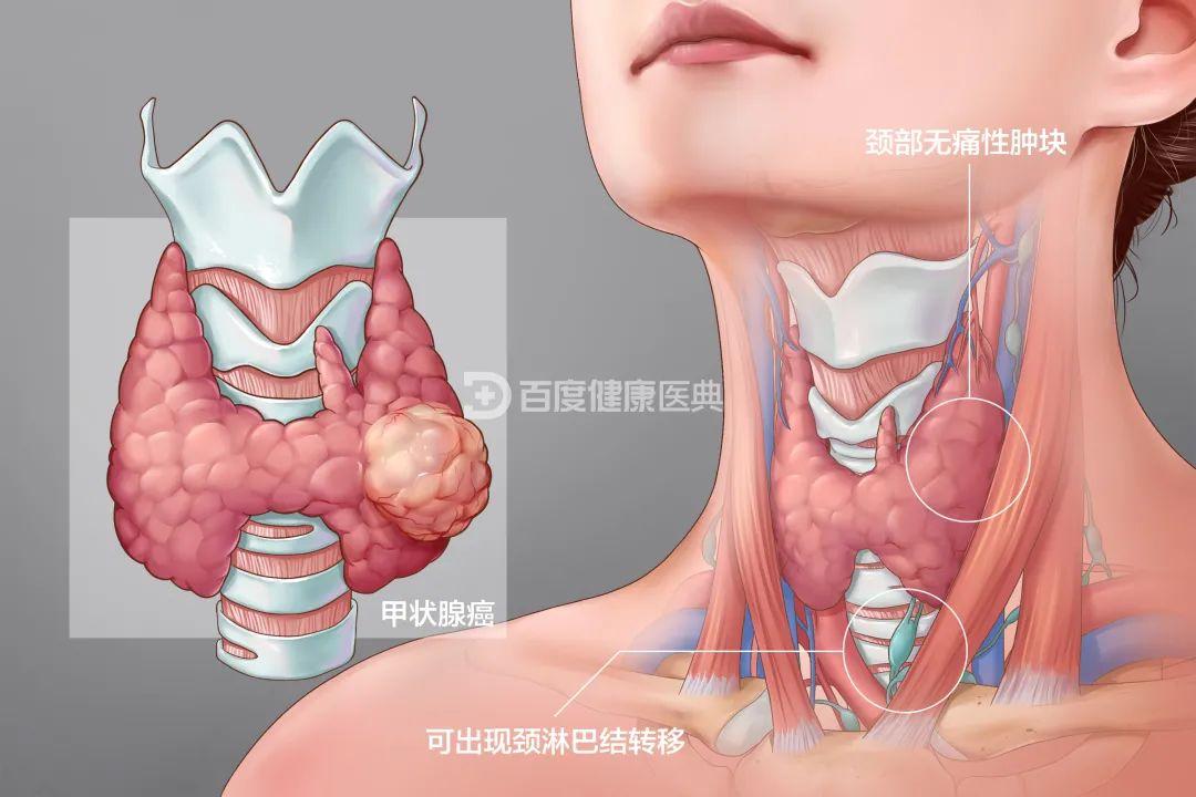 2年未复查甲状腺结节成癌这病为什么总找上女人